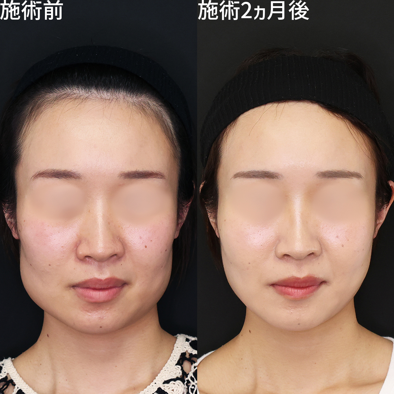 TAC式 ツヤ肌コラーゲンリフト®/エラボトックス注射/ヒアルロン酸注射:その他の症例写真 施術前後