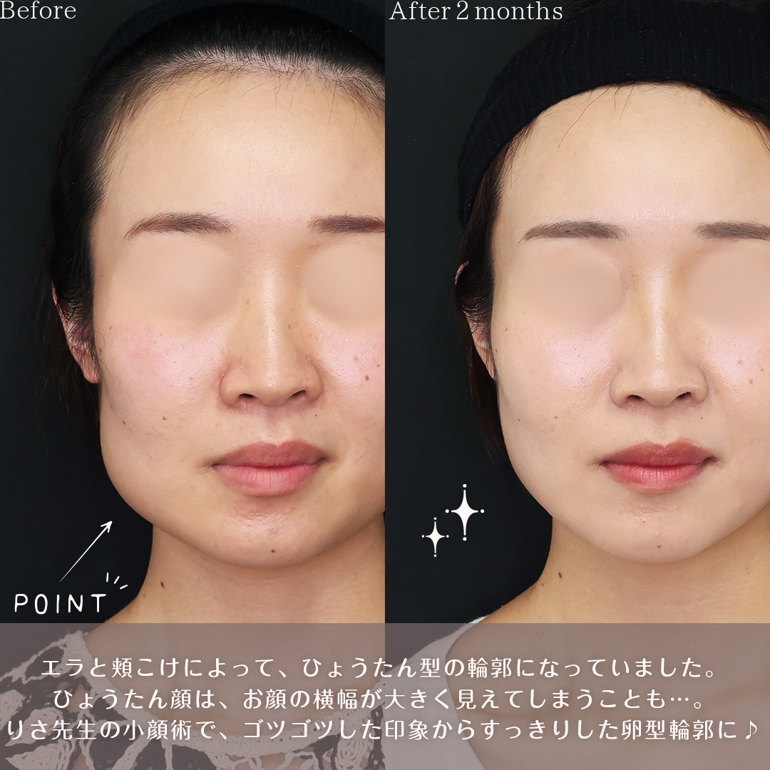 TAC式 ツヤ肌コラーゲンリフト®/エラボトックス注射/ヒアルロン酸注射:その他の症例写真 施術前後