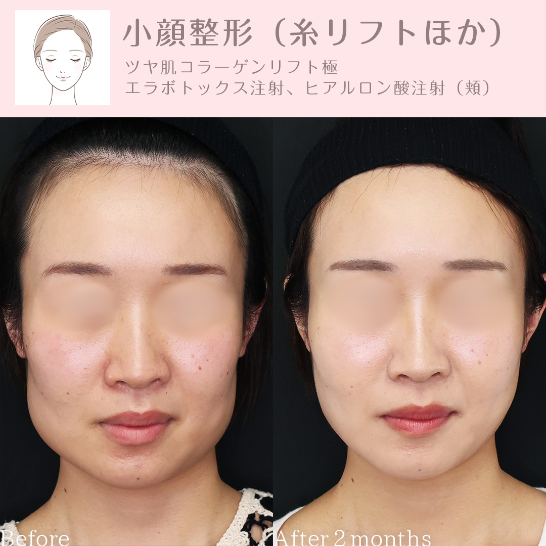 TAC式 ツヤ肌コラーゲンリフト®/エラボトックス注射/ヒアルロン酸注射:その他の症例写真 施術前後