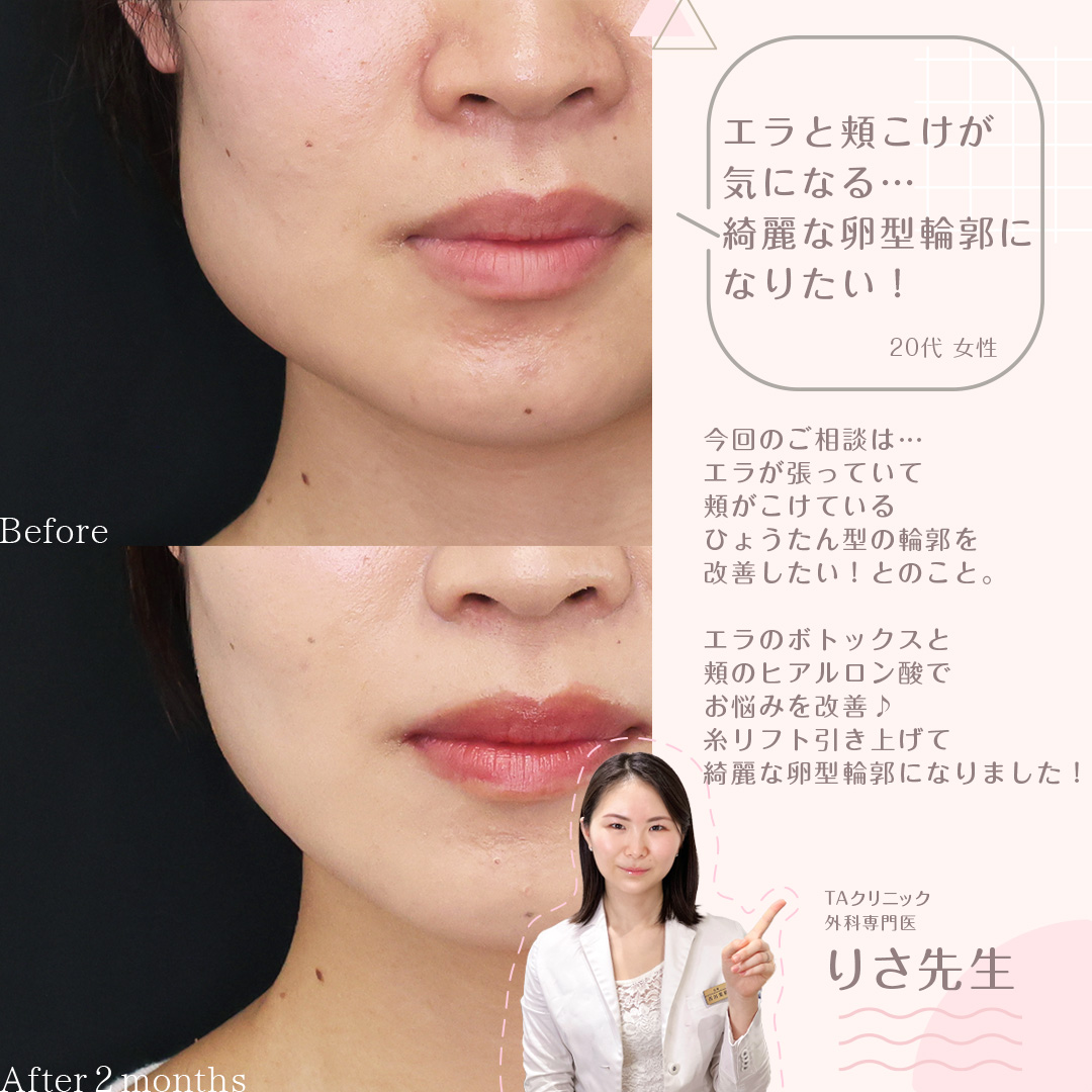 TAC式 ツヤ肌コラーゲンリフト®/エラボトックス注射/ヒアルロン酸注射:その他の症例写真 施術前後