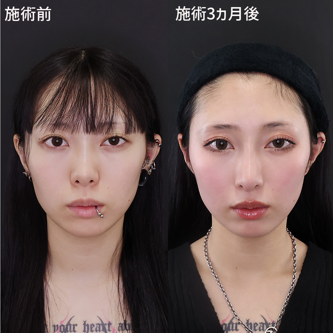 鼻中隔延長術/鼻尖形成・鼻尖縮小/隆鼻術(プロテーゼ・自家組織)の症例写真 施術前後
