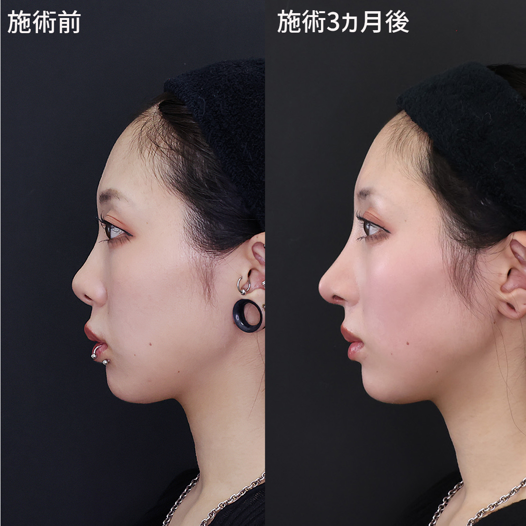鼻中隔延長術/鼻尖形成・鼻尖縮小/隆鼻術(プロテーゼ・自家組織)の症例写真 施術前後