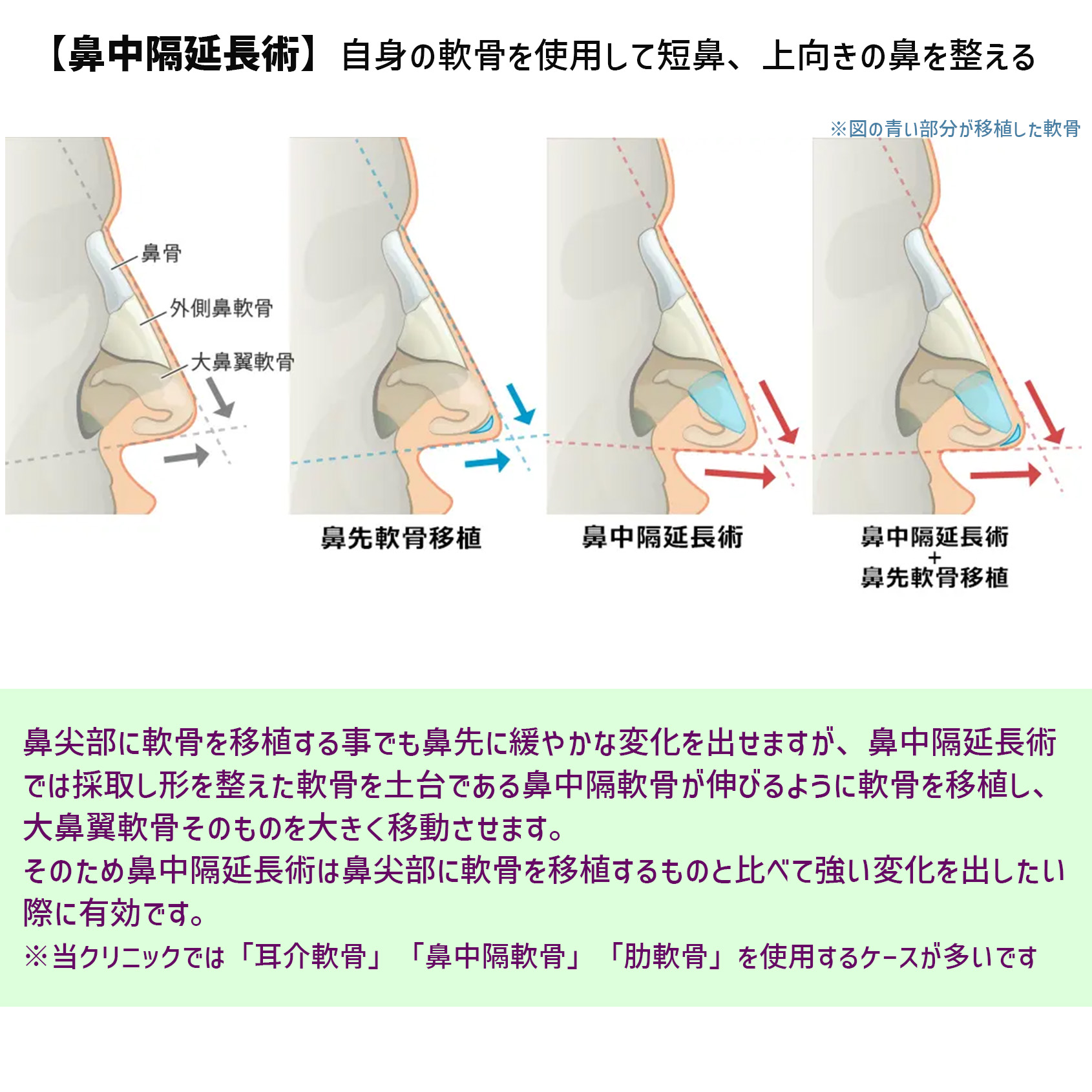 鼻中隔延長術/鼻尖形成・鼻尖縮小/隆鼻術(プロテーゼ・自家組織)の症例写真 施術前後
