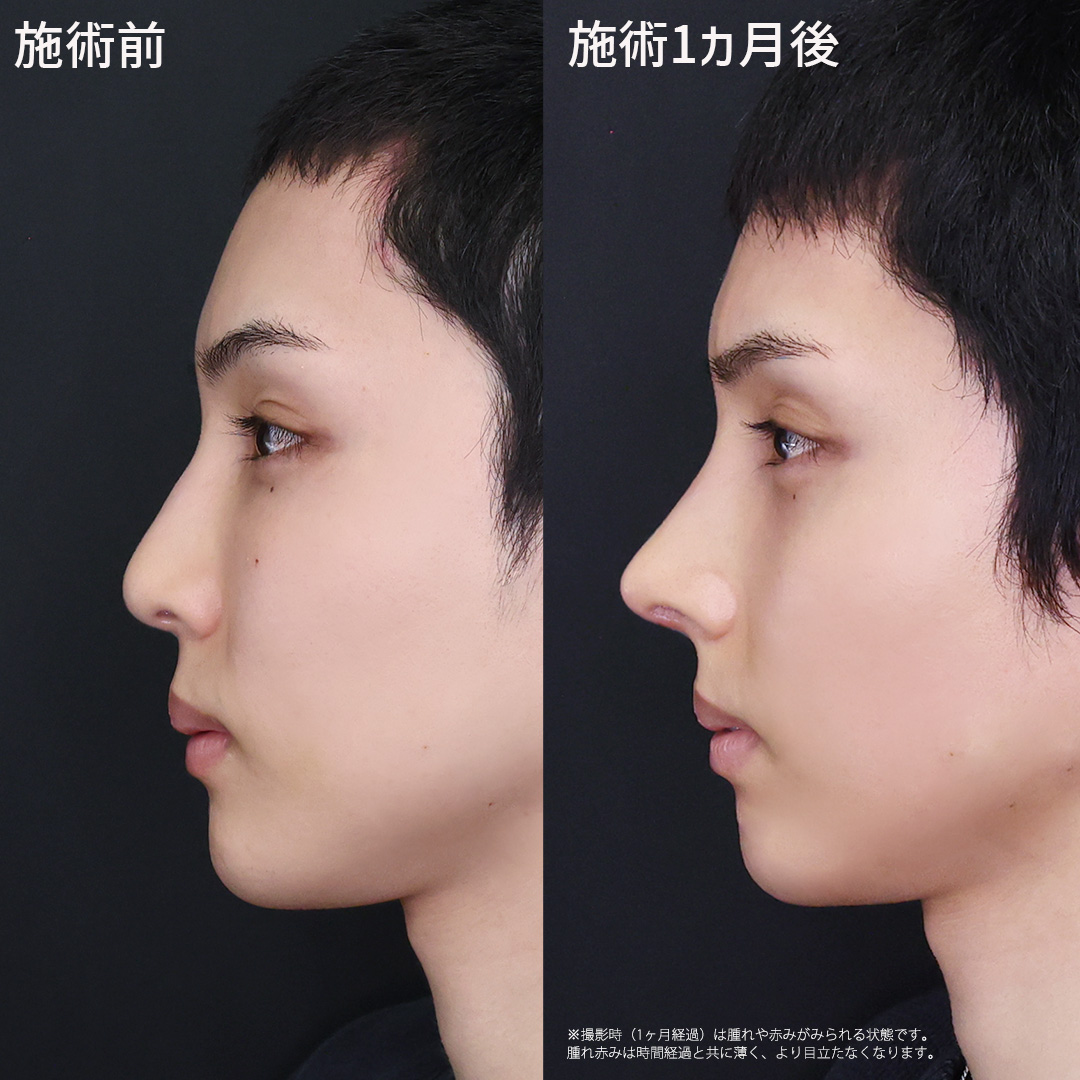 程よい高さ、自然な仕上がりの【忘れ鼻】へ