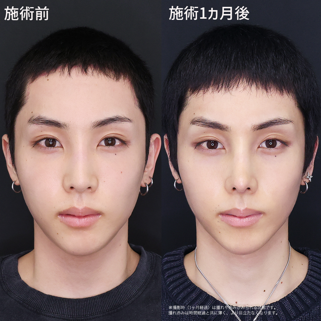 鼻中隔延長術/鼻先軟骨移植/鼻尖形成・鼻尖縮小の症例写真 施術前後 