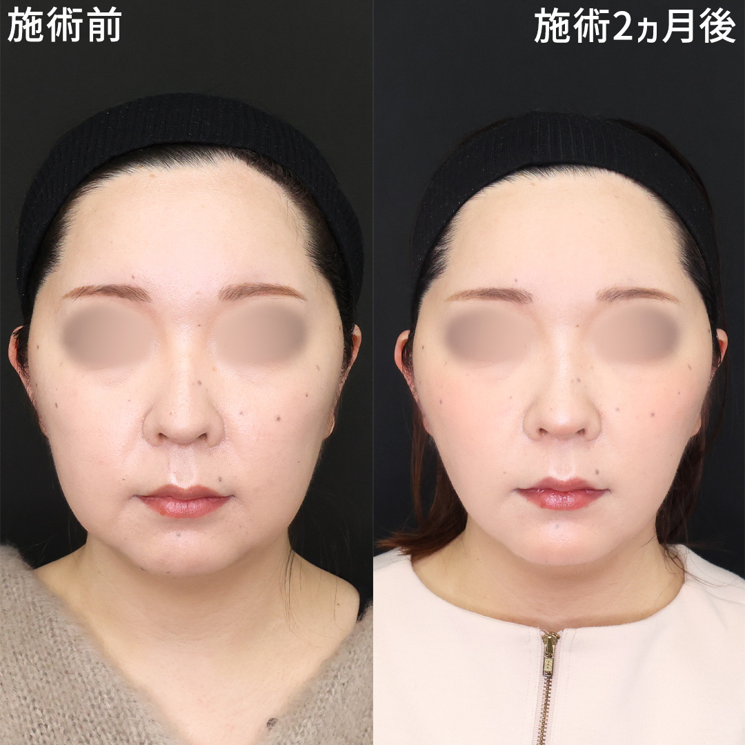 たるみ解消！若返りの小顔術