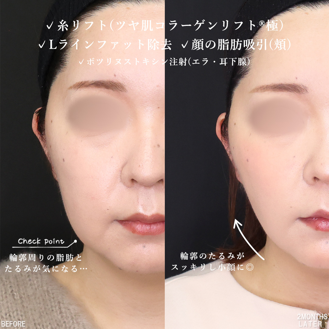 TAC式 ツヤ肌コラーゲンリフト®/顔の脂肪吸引/Lラインファット除去（エラ下脂肪除去）の症例写真 施術前後 