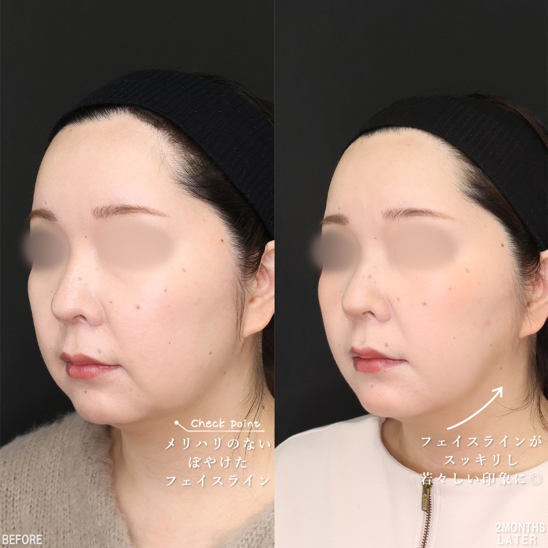 TAC式 ツヤ肌コラーゲンリフト®/顔の脂肪吸引/Lラインファット除去（エラ下脂肪除去）の症例写真 施術前後 