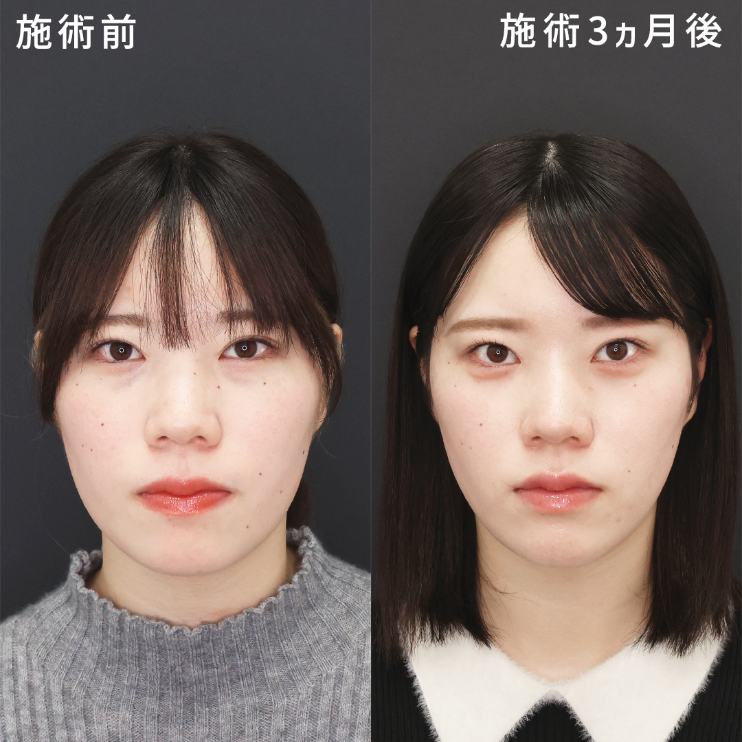 【小顔×クマ取り】20代の垢抜け整形複合術