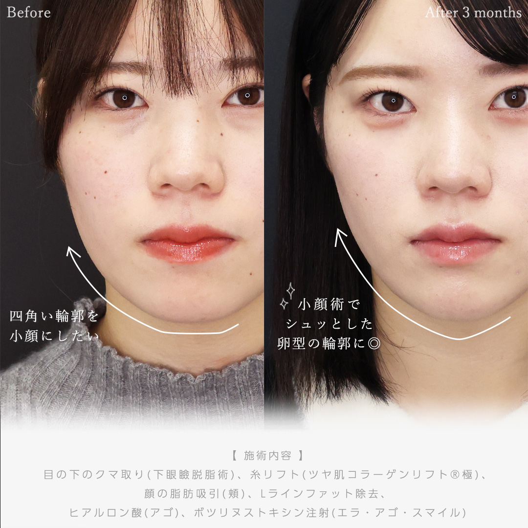 下眼瞼脱脂術（目の下のたるみ取り・目の下の脂肪ふくらみ取り）/顔の脂肪吸引/Lラインファット除去（エラ下脂肪除去）の症例写真 施術前後 