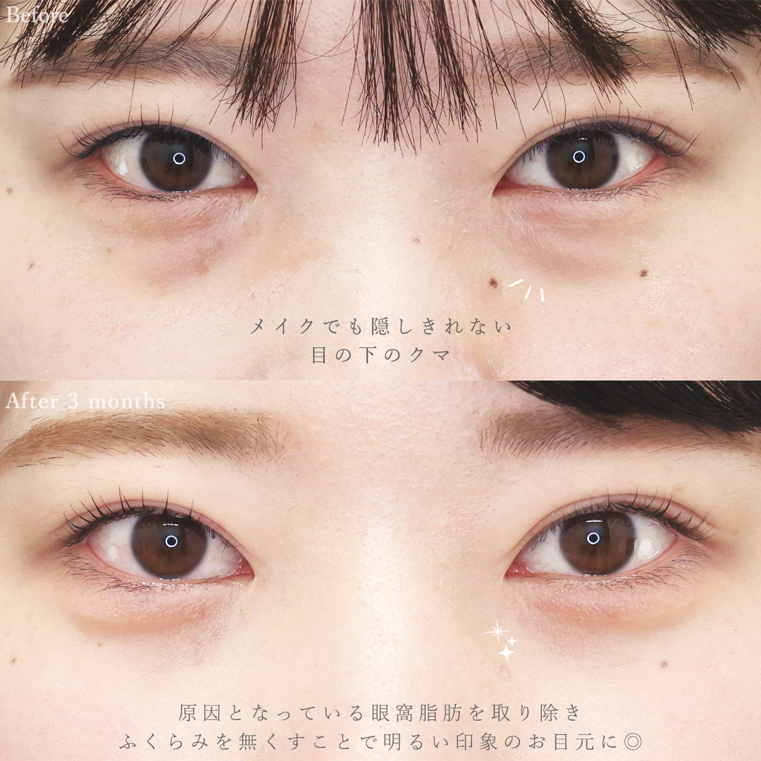 下眼瞼脱脂術（目の下のたるみ取り・目の下の脂肪ふくらみ取り）/顔の脂肪吸引/Lラインファット除去（エラ下脂肪除去）の症例写真 施術前後 