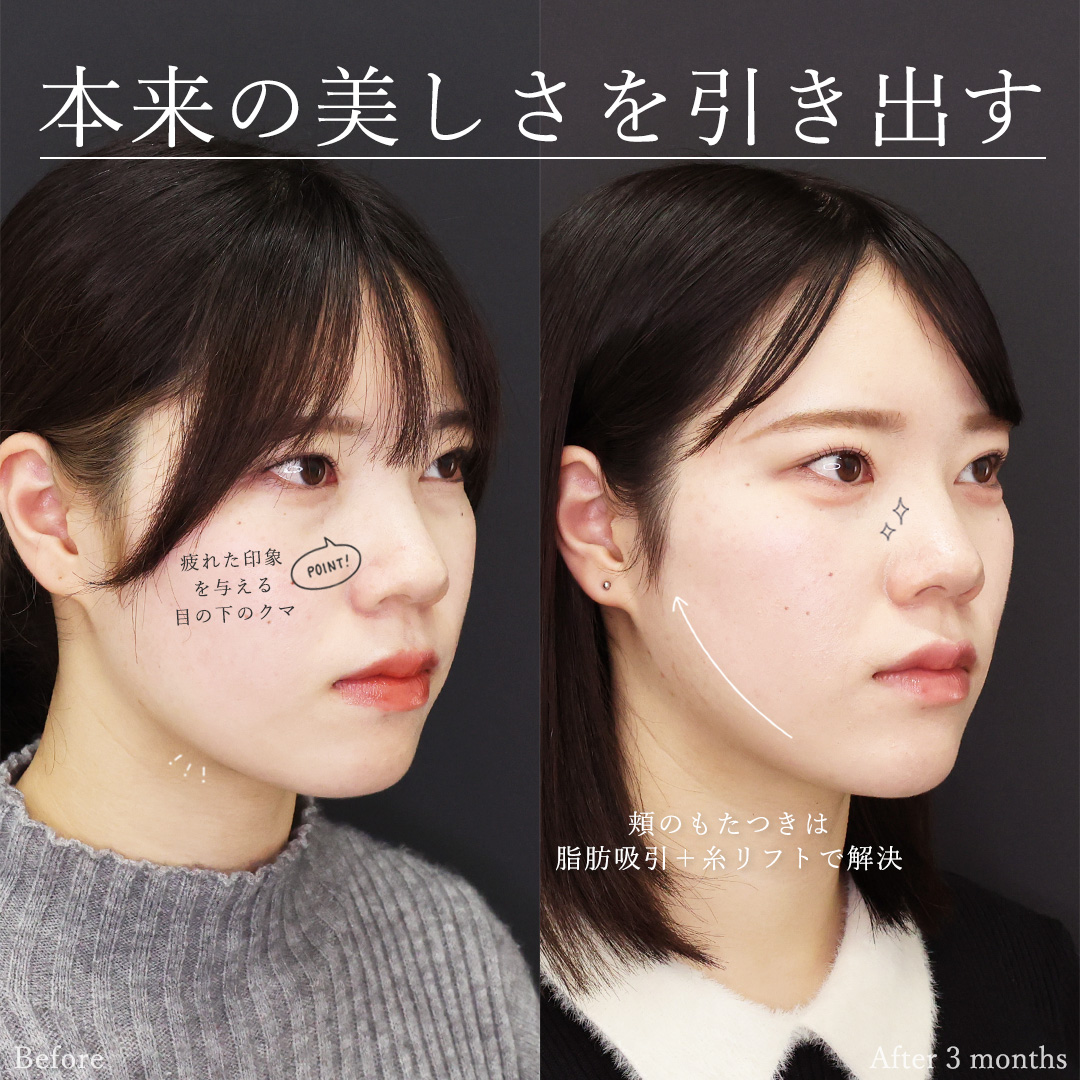 下眼瞼脱脂術（目の下のたるみ取り・目の下の脂肪ふくらみ取り）/顔の脂肪吸引/Lラインファット除去（エラ下脂肪除去）の症例写真 施術前後 