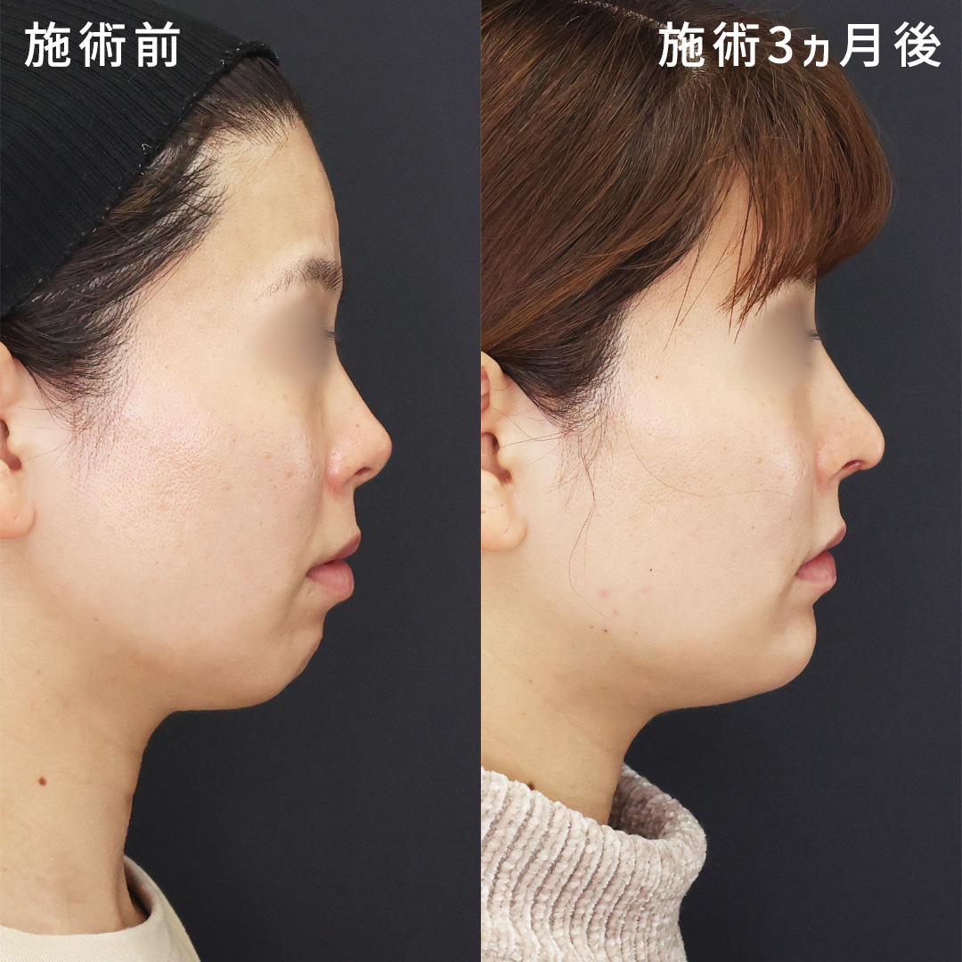 上に向いた鼻先を改善し、忘れ鼻を形成|Eラインも整える
