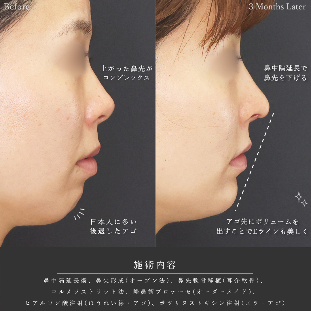 鼻中隔延長術/鼻尖形成・鼻尖縮小/隆鼻術（プロテーゼ・自家組織）の症例写真 施術前後 