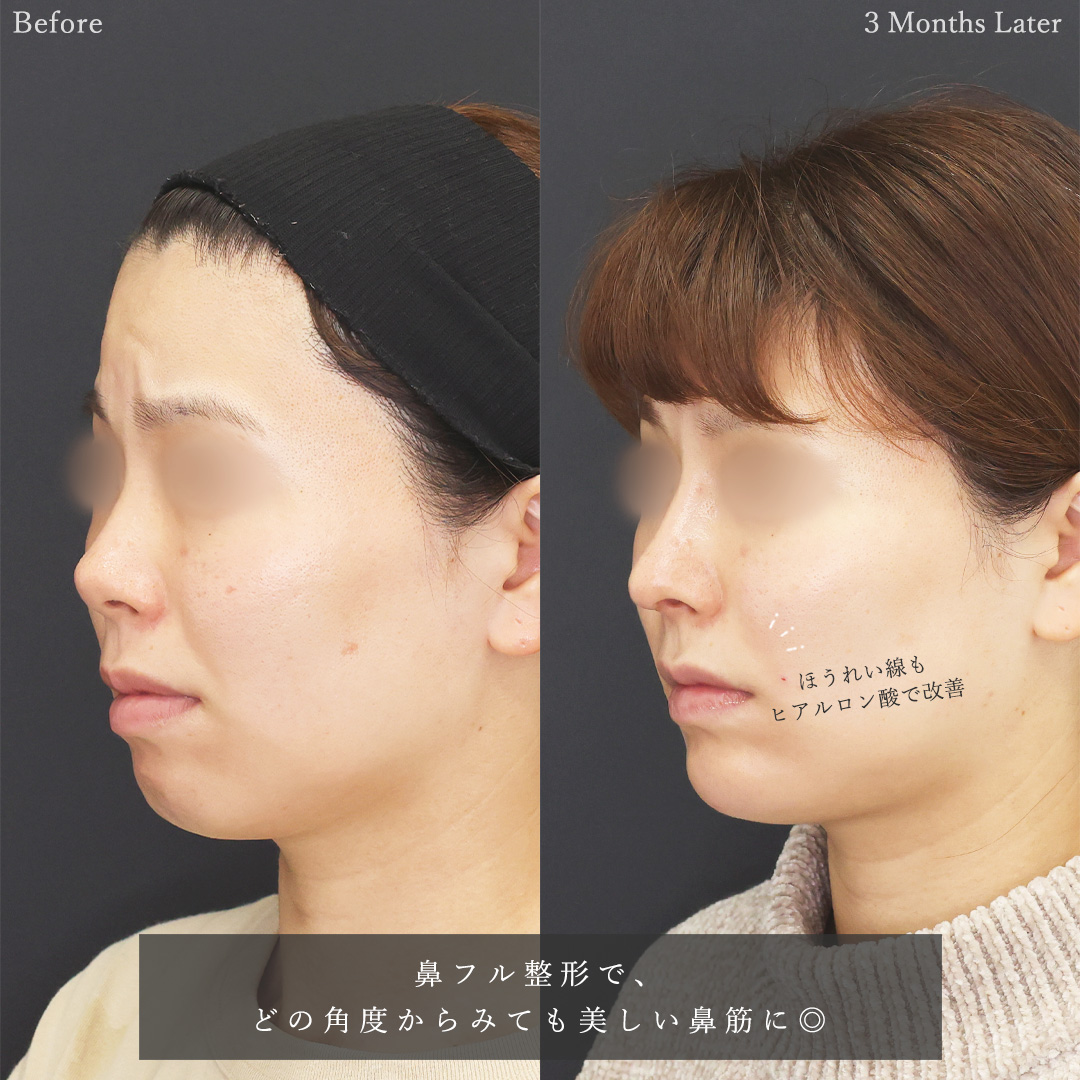 鼻中隔延長術/鼻尖形成・鼻尖縮小/隆鼻術（プロテーゼ・自家組織）の症例写真 施術前後 