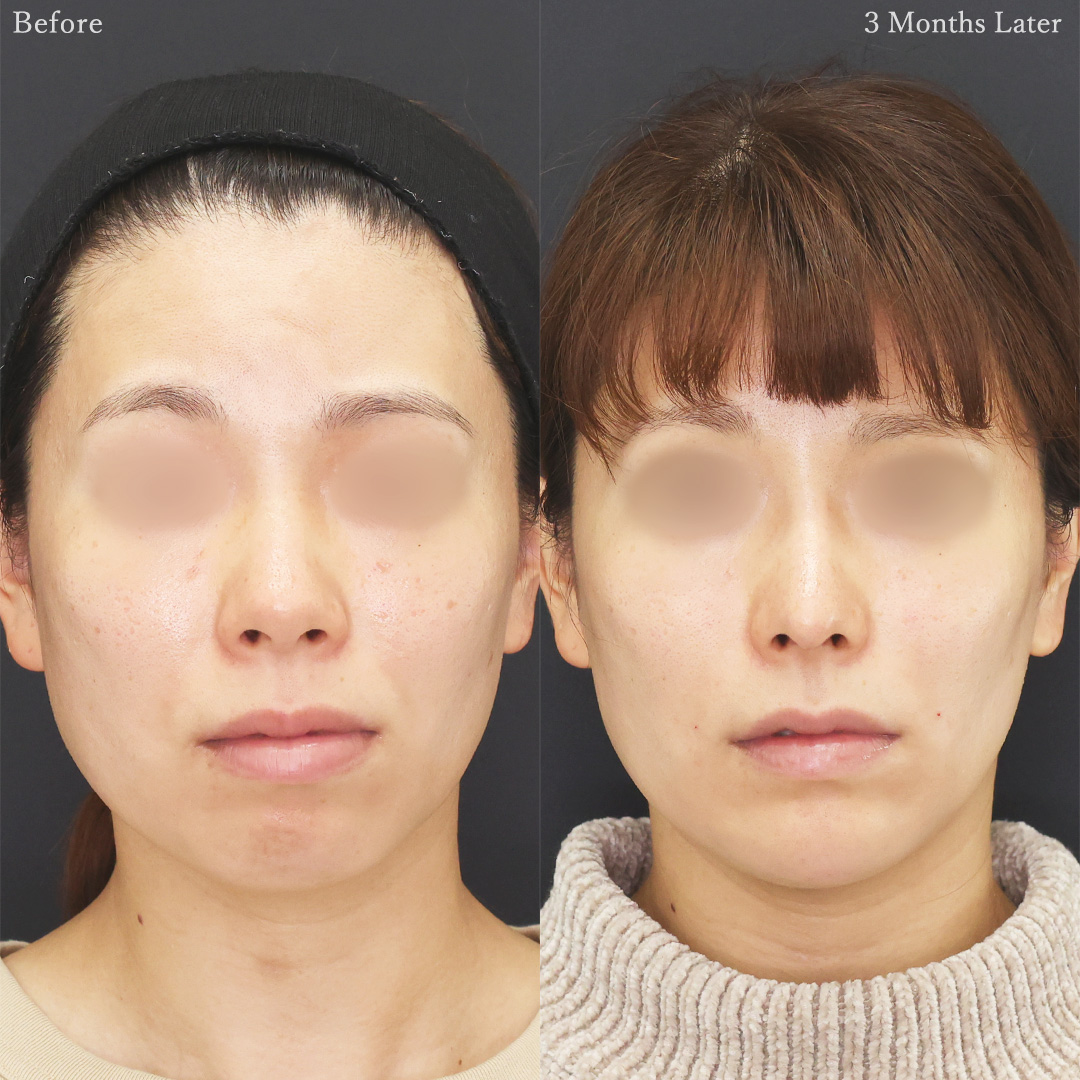 鼻中隔延長術/鼻尖形成・鼻尖縮小/隆鼻術（プロテーゼ・自家組織）の症例写真 施術前後 