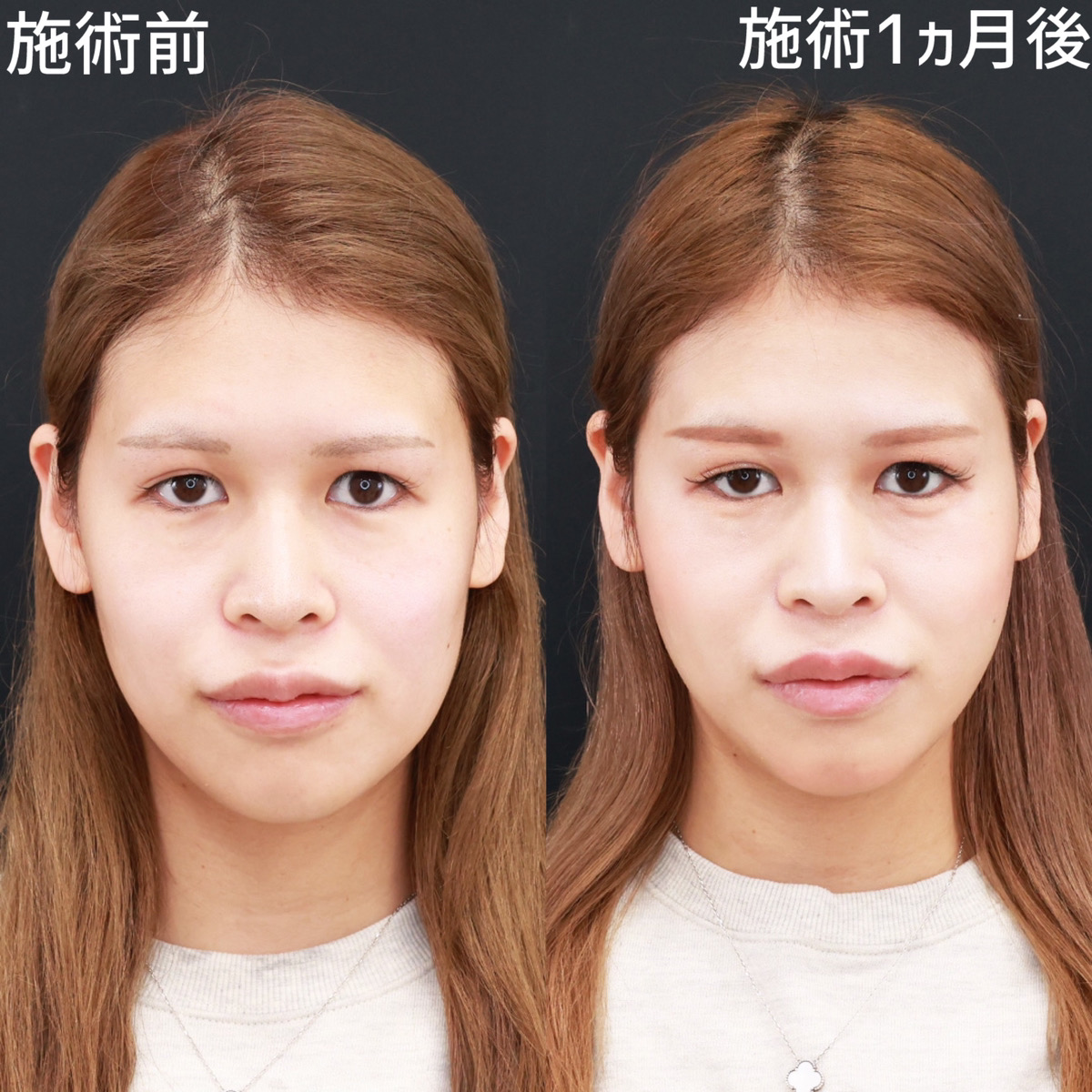 【糸リフト極】高いリフトアップ力で、下顔面をスッキリ!