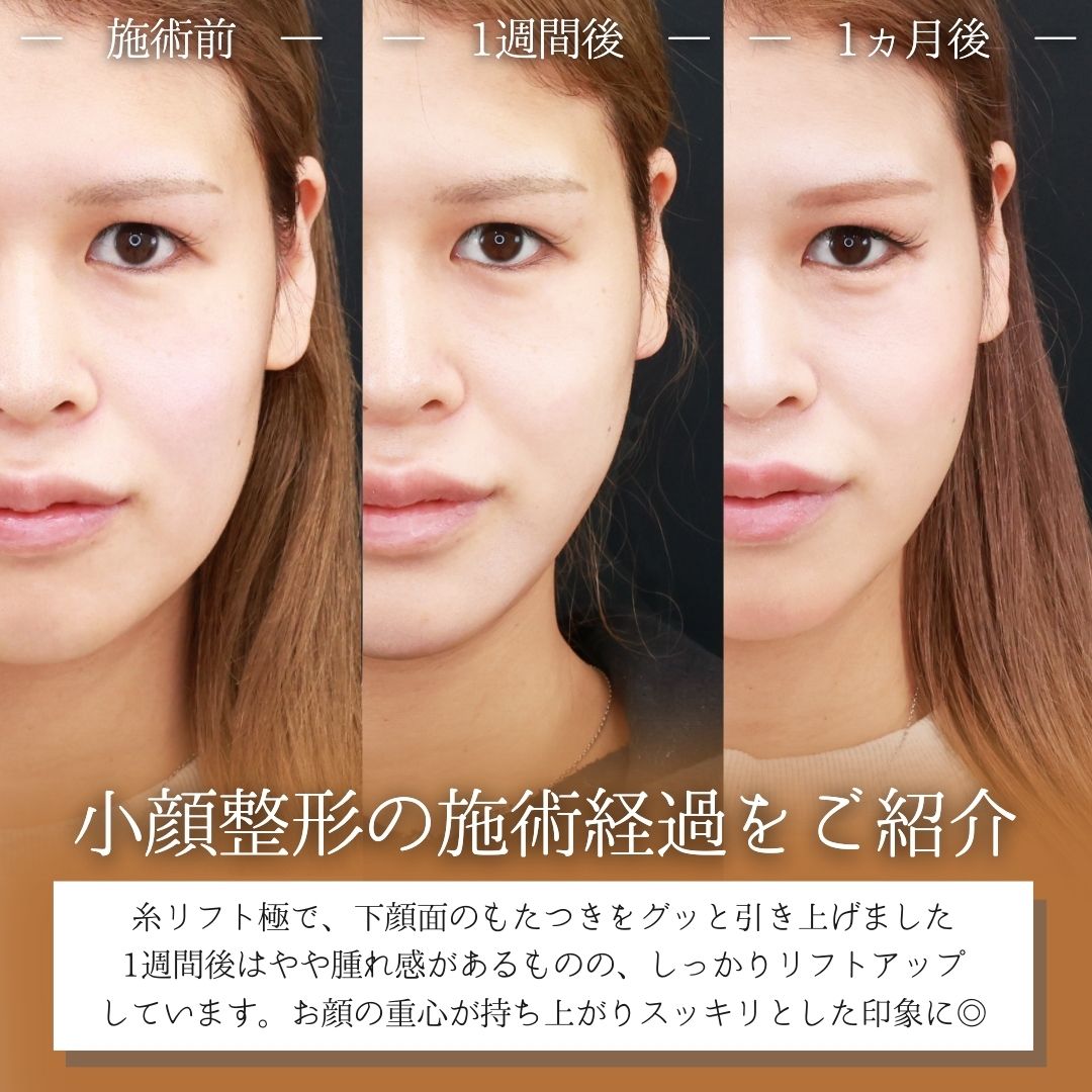 TAC式 ツヤ肌コラーゲンリフト®/顔の脂肪吸引の症例写真 施術前後 