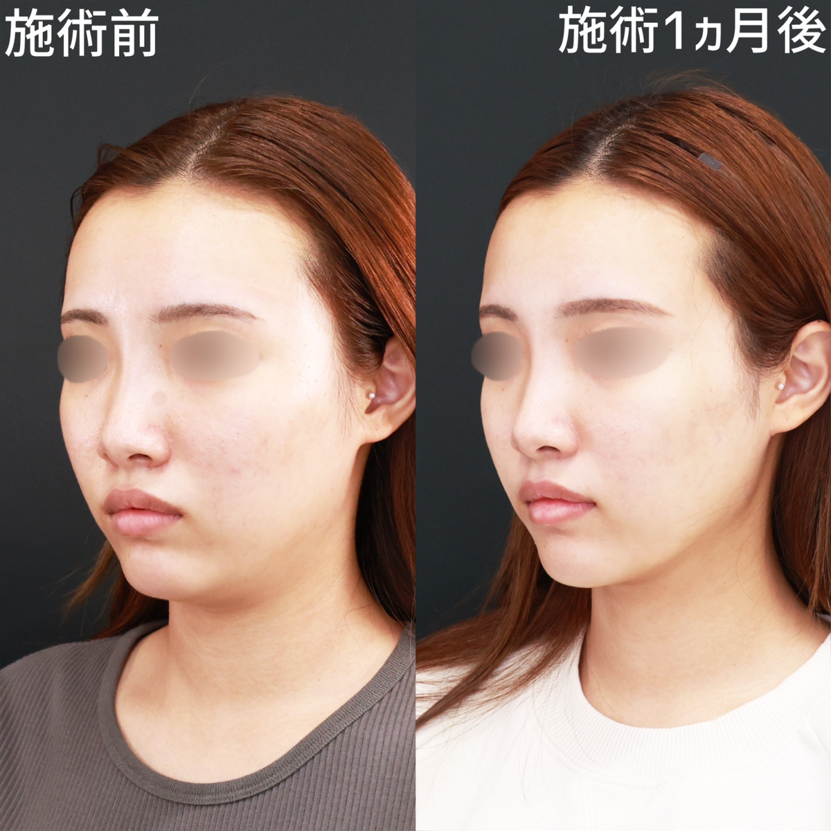 【顎下脂肪吸引×糸リフト極】ぼやけたフェイスラインを、クッキリさせる！