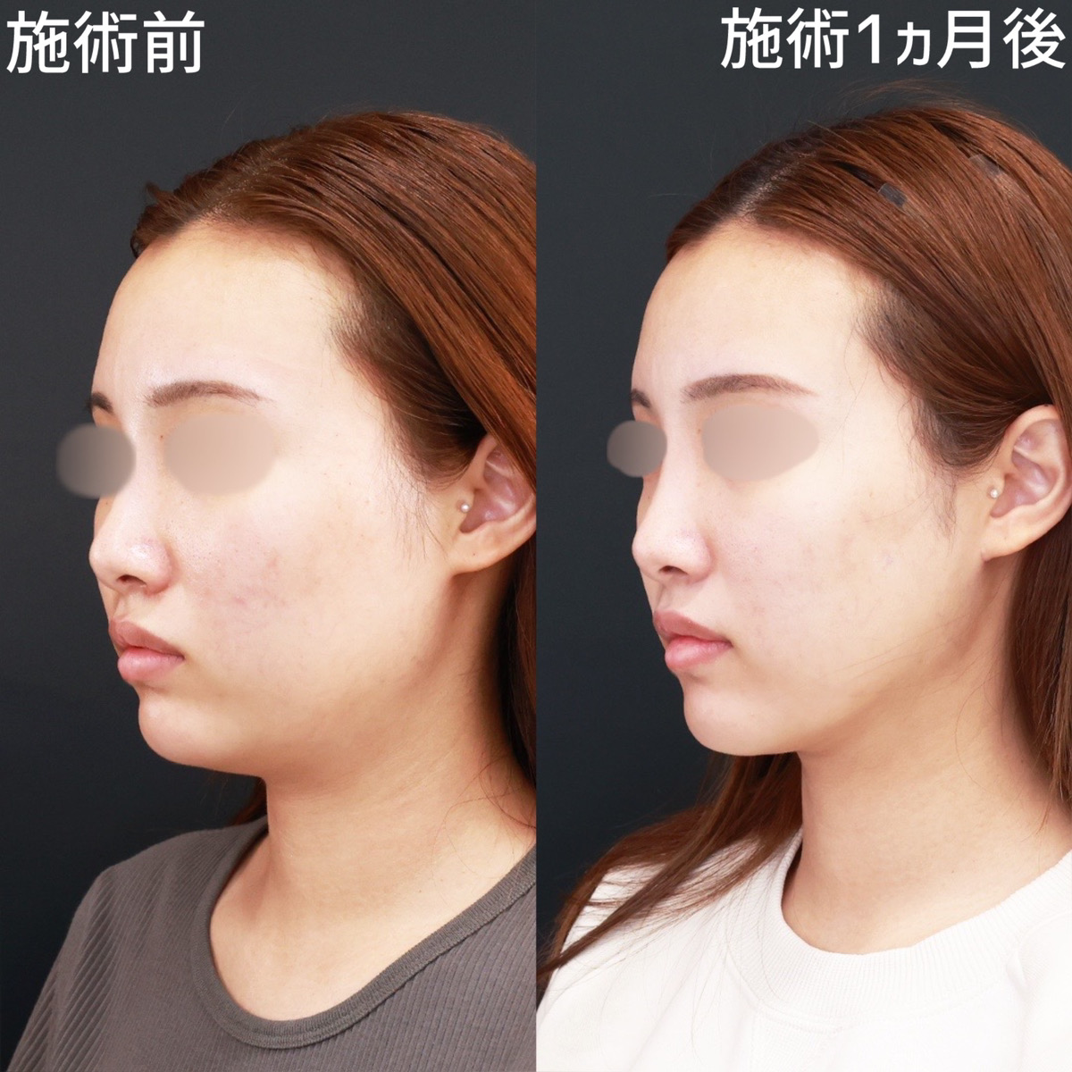 TAC式 ツヤ肌コラーゲンリフト®/顔の脂肪吸引/Lラインファット除去(エラ下脂肪除去)の症例写真 施術前後