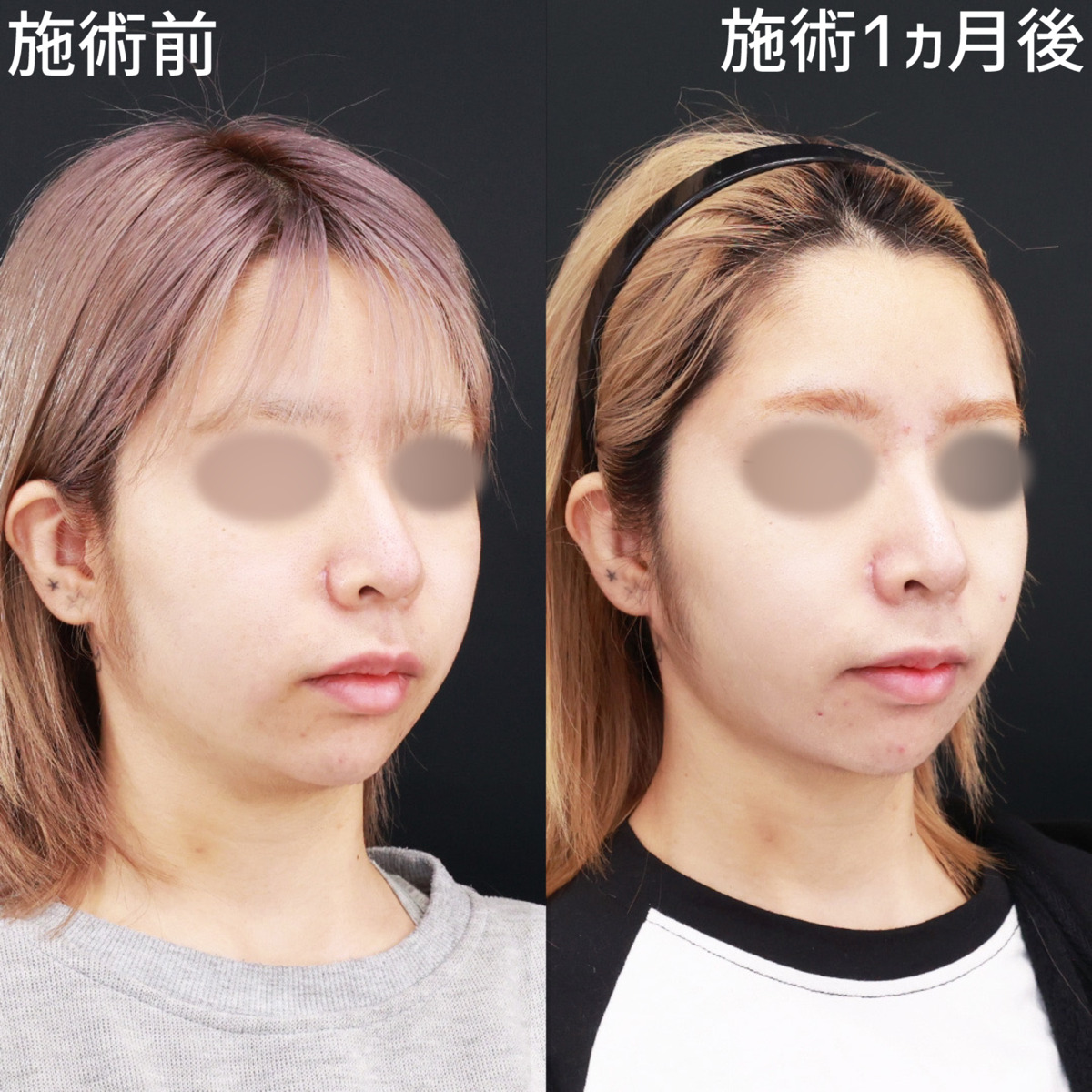 TAC式 ツヤ肌コラーゲンリフト®/顔の脂肪吸引/Lラインファット除去(エラ下脂肪除去)の症例写真 施術前後