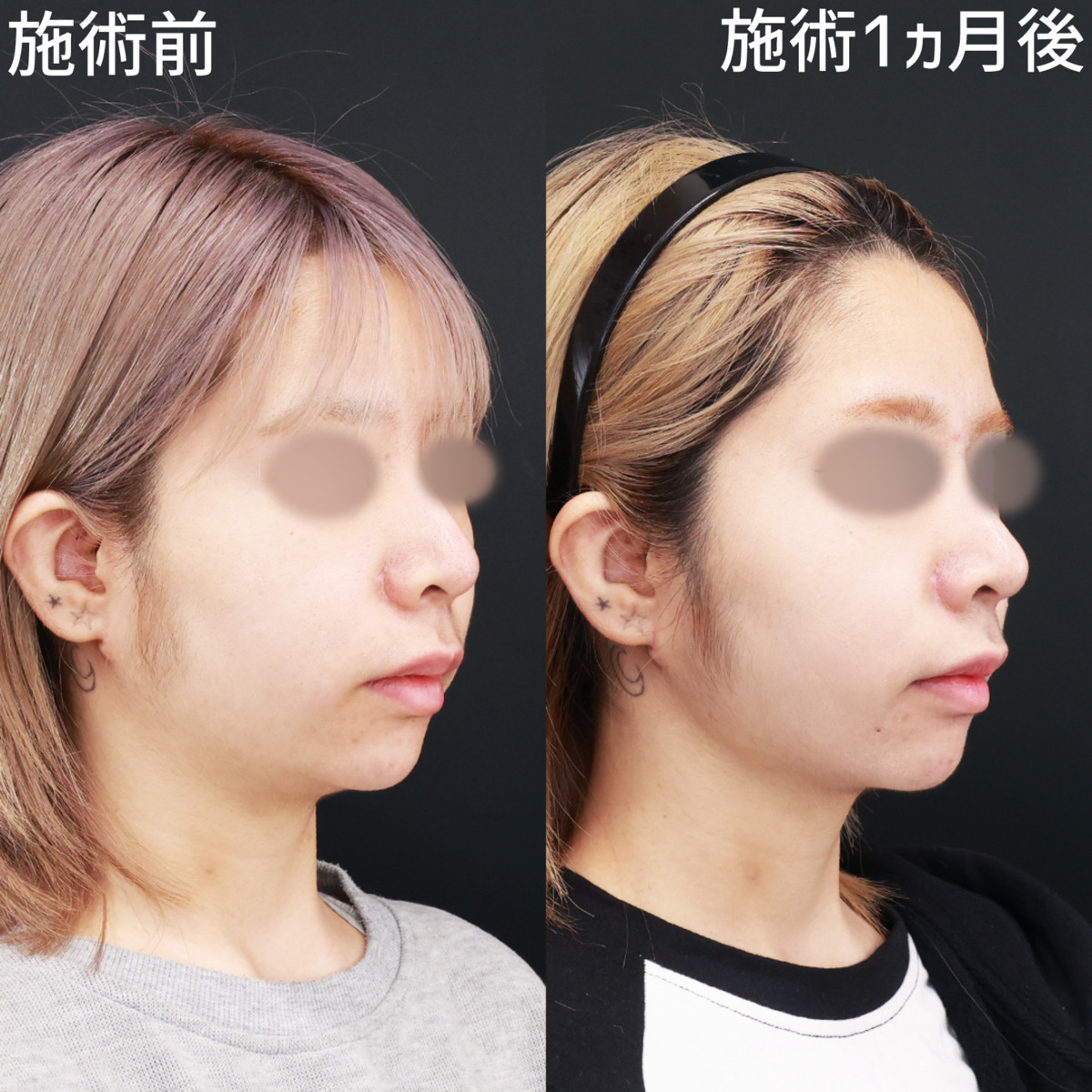 TAC式 ツヤ肌コラーゲンリフト®/顔の脂肪吸引/Lラインファット除去(エラ下脂肪除去)の症例写真 施術前後