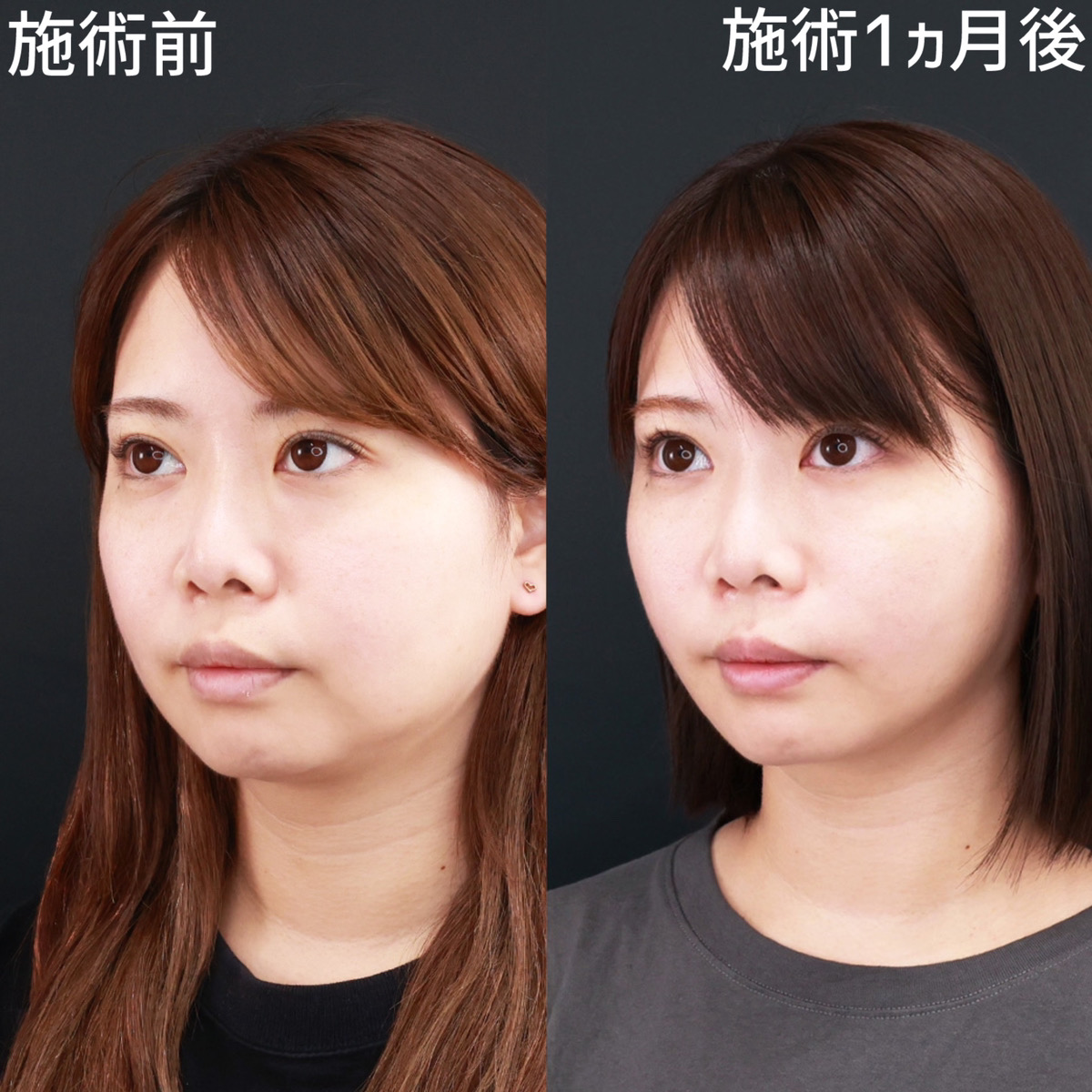 【脂肪吸引×糸リフト極】口元のもたつきを解消し、スッキリ小顔に！