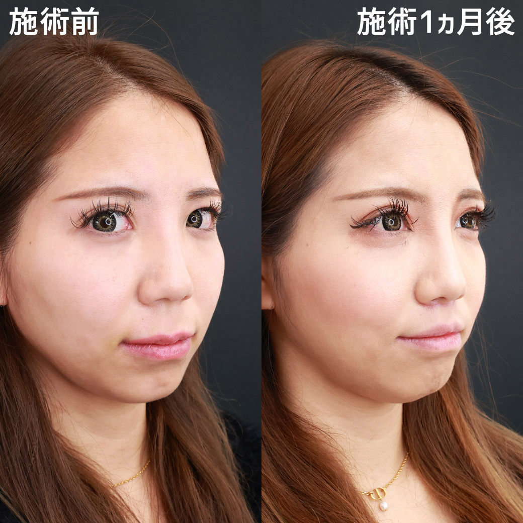 人中短縮術(リップリフト)・外側人中短縮術の症例写真 施術前後