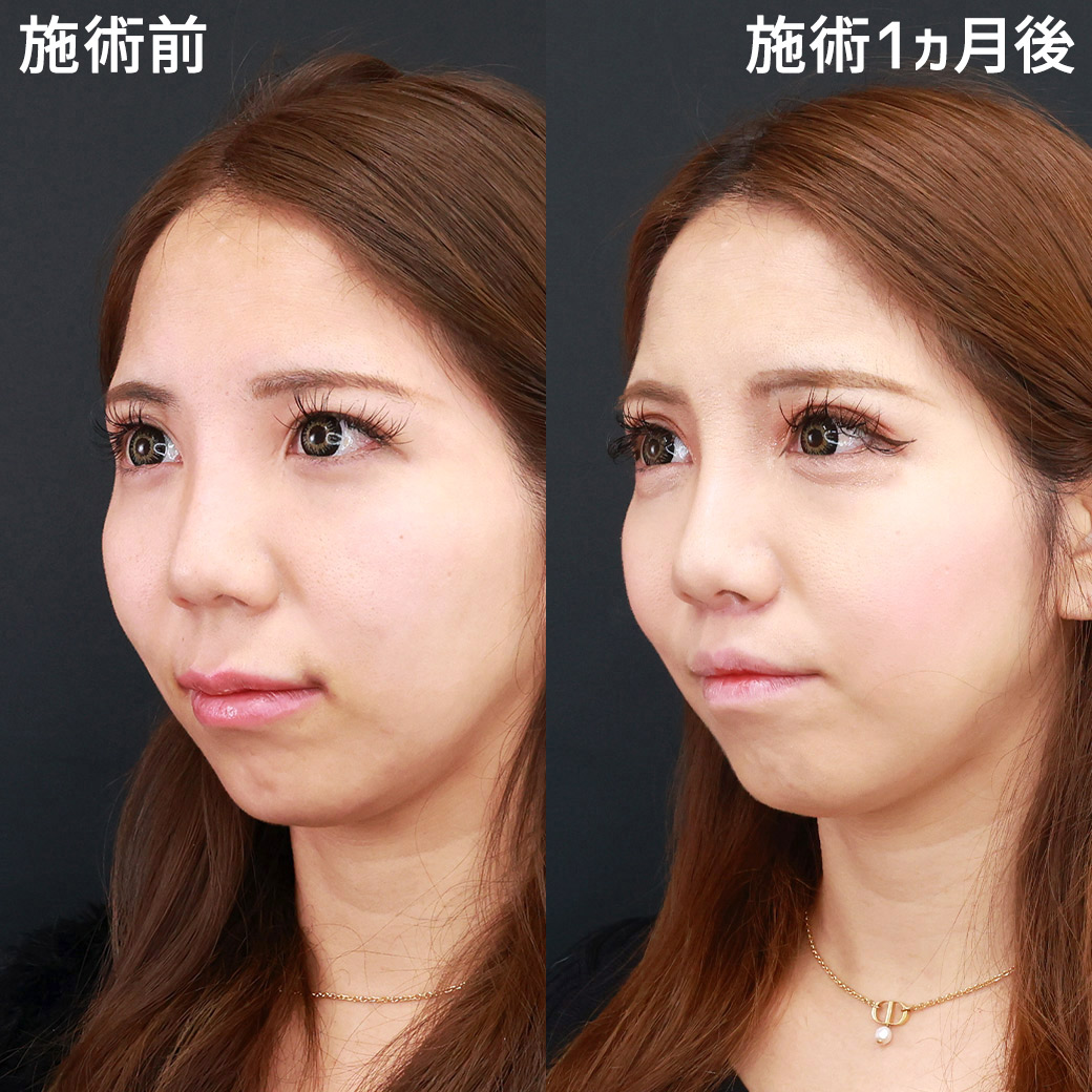 人中短縮術(リップリフト)・外側人中短縮術の症例写真 施術前後