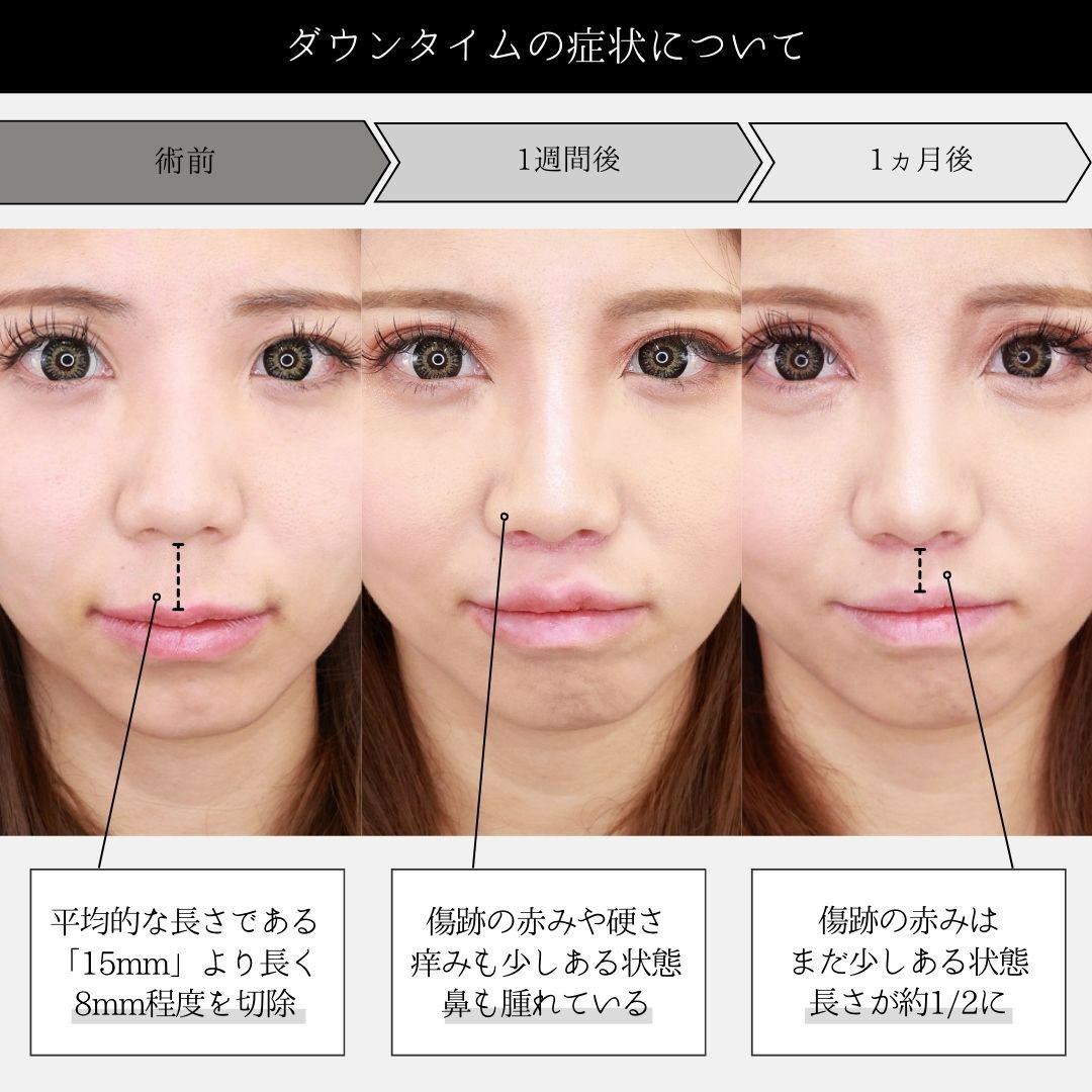 人中短縮術(リップリフト)・外側人中短縮術の症例写真 施術前後