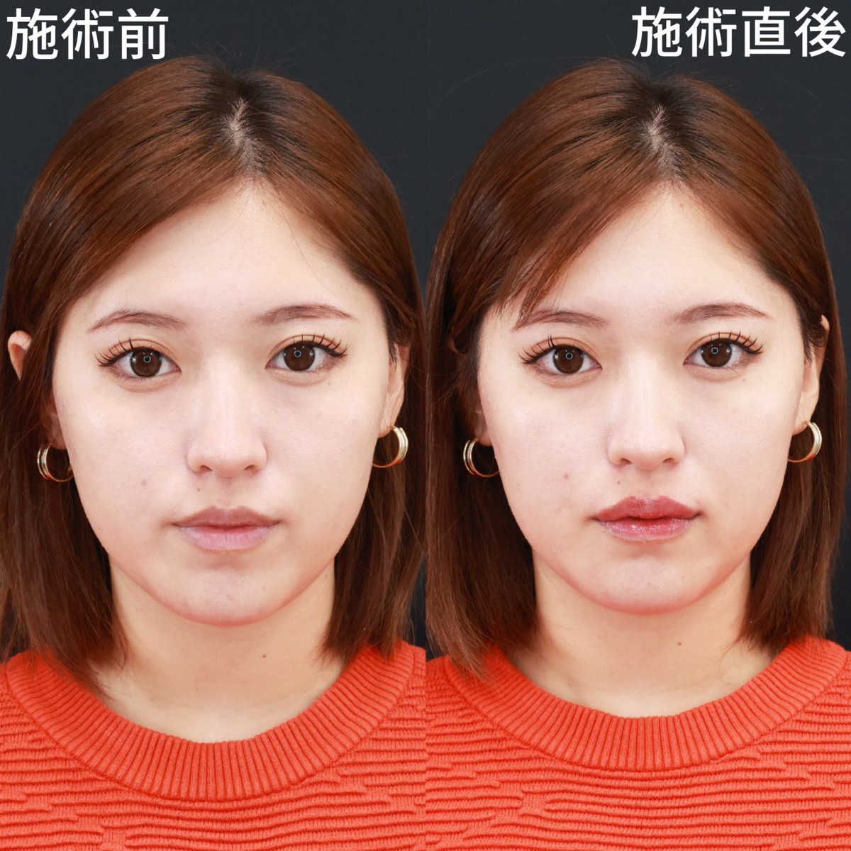 【唇ヒアルロン酸注射】ふっくらとした、色っぽい唇に！