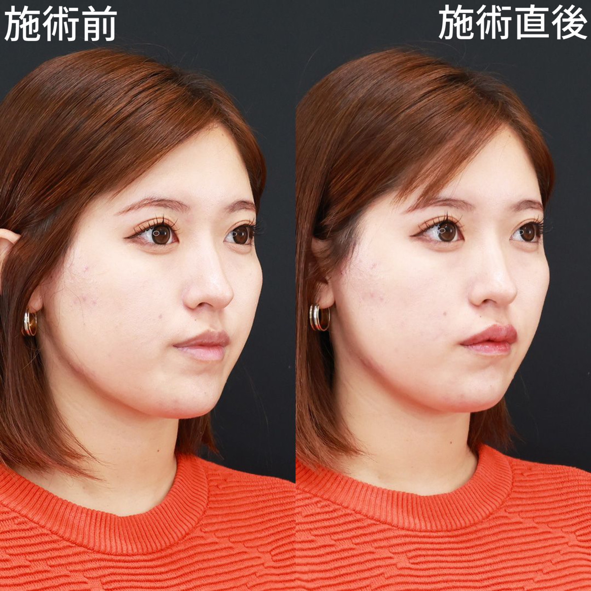 の症例写真 施術前後 