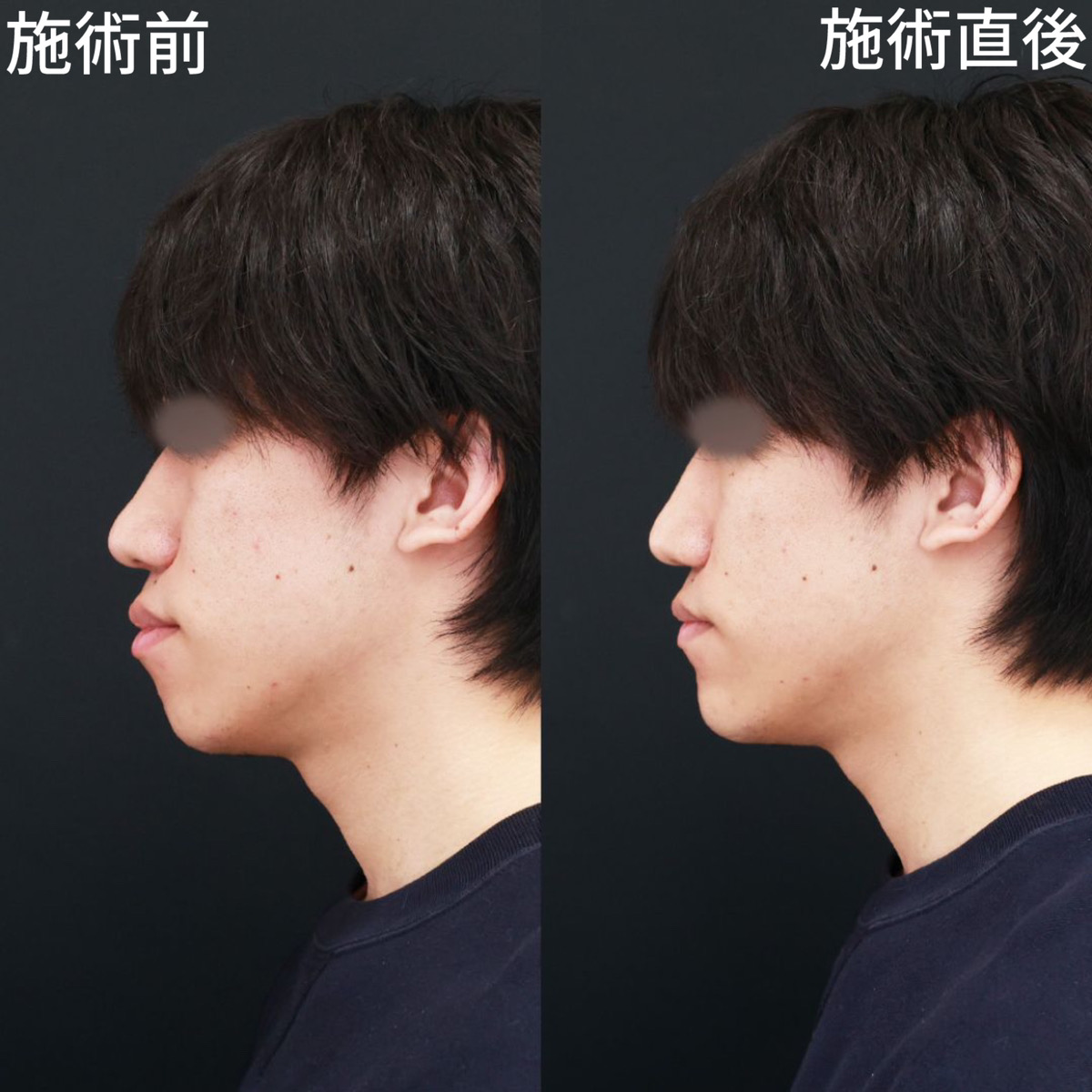 【顎ヒアルロン酸注射】顎先を前に出して、口ゴボを解消！