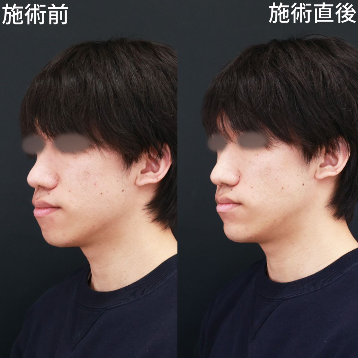 顎のヒアルロン酸注射/ほうれい線のヒアルロン酸注射の症例写真 施術前後 