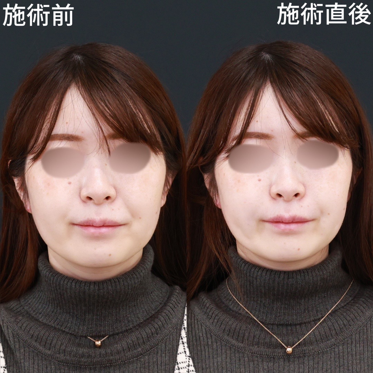 【法令線ヒアルロン酸】法令線を解消して見た目年齢を若く！