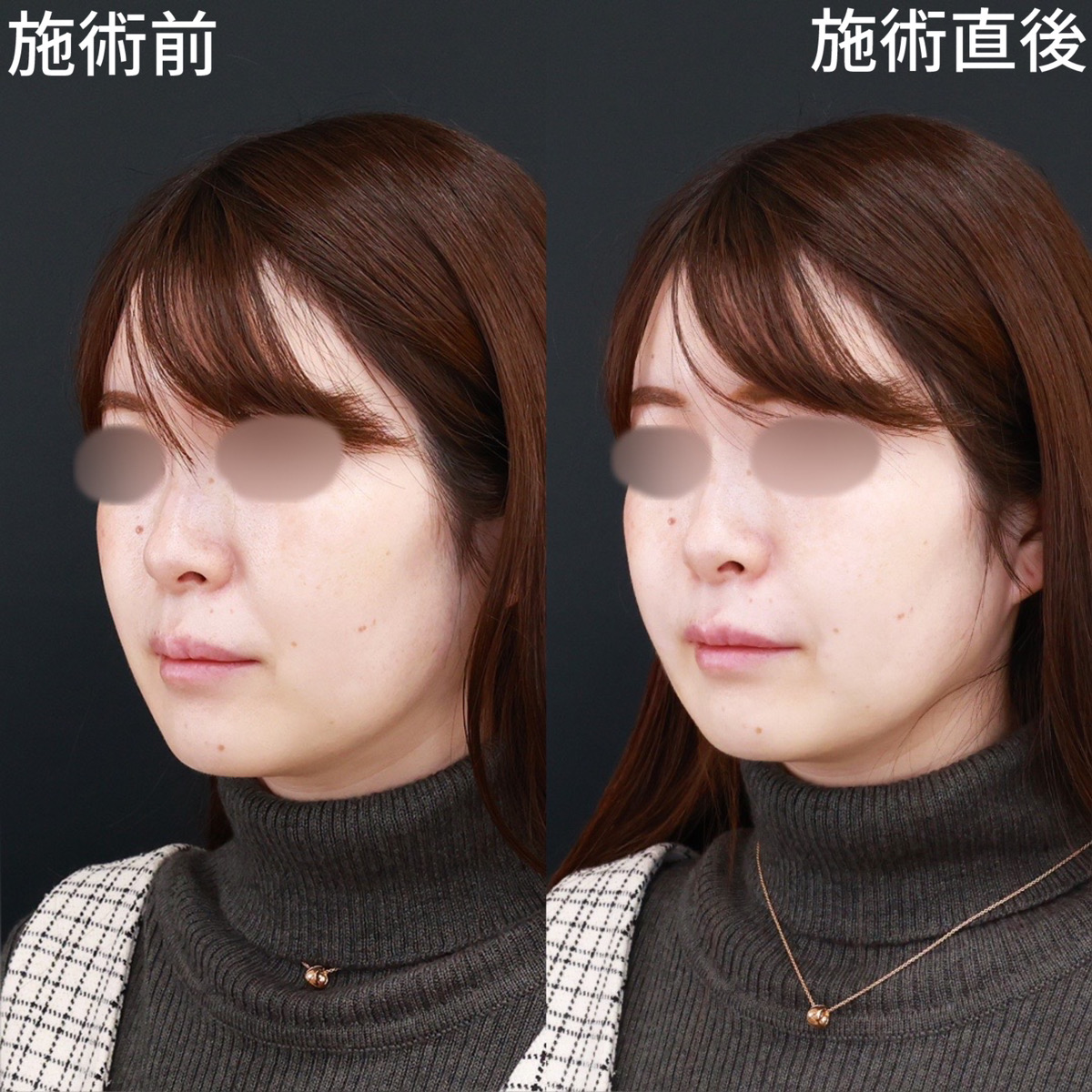 ほうれい線のヒアルロン酸注射の症例写真 施術前後 