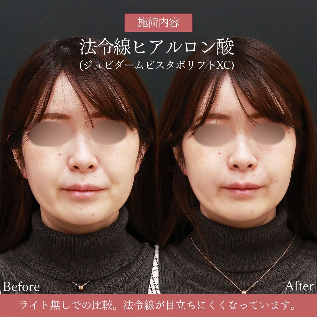 ほうれい線のヒアルロン酸注射の症例写真 施術前後 