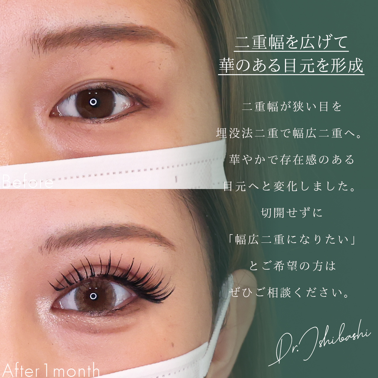 二重埋没法の症例写真 施術前後 