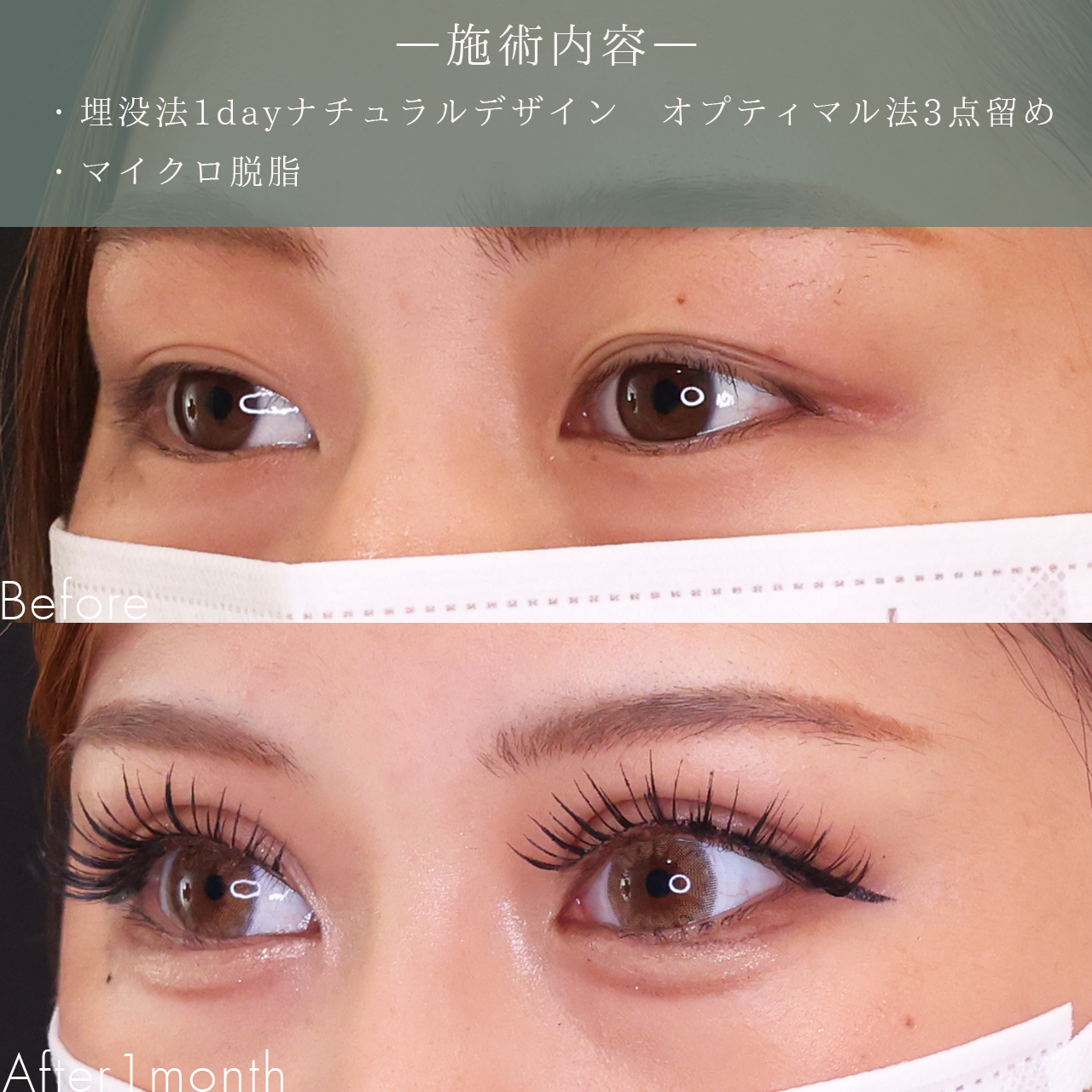 二重埋没法の症例写真 施術前後 