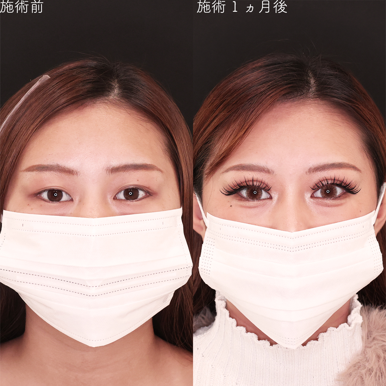 二重埋没法の症例写真 施術前後 