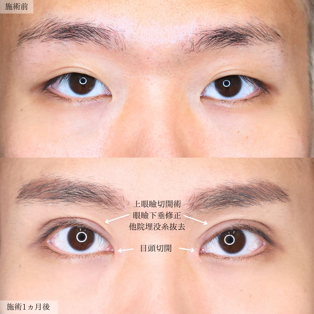 上眼瞼切開術/眼瞼下垂（目つき矯正）/目頭切開術の症例写真 施術前後 