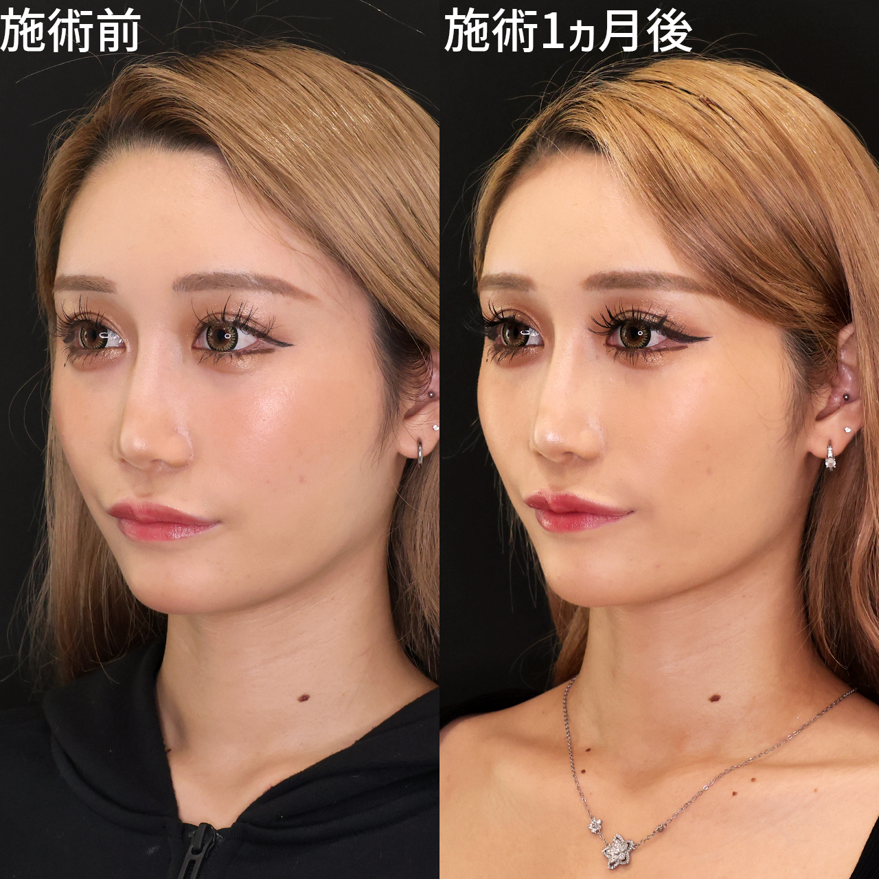美しさを引き出してトップモデル級の小顔に