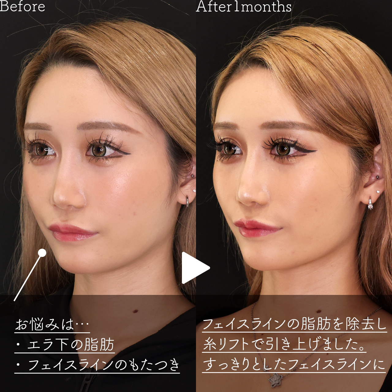 TAC式 ツヤ肌コラーゲンリフト®/Lラインファット除去（エラ下脂肪除去）/顎のヒアルロン酸注射の症例写真 施術前後 