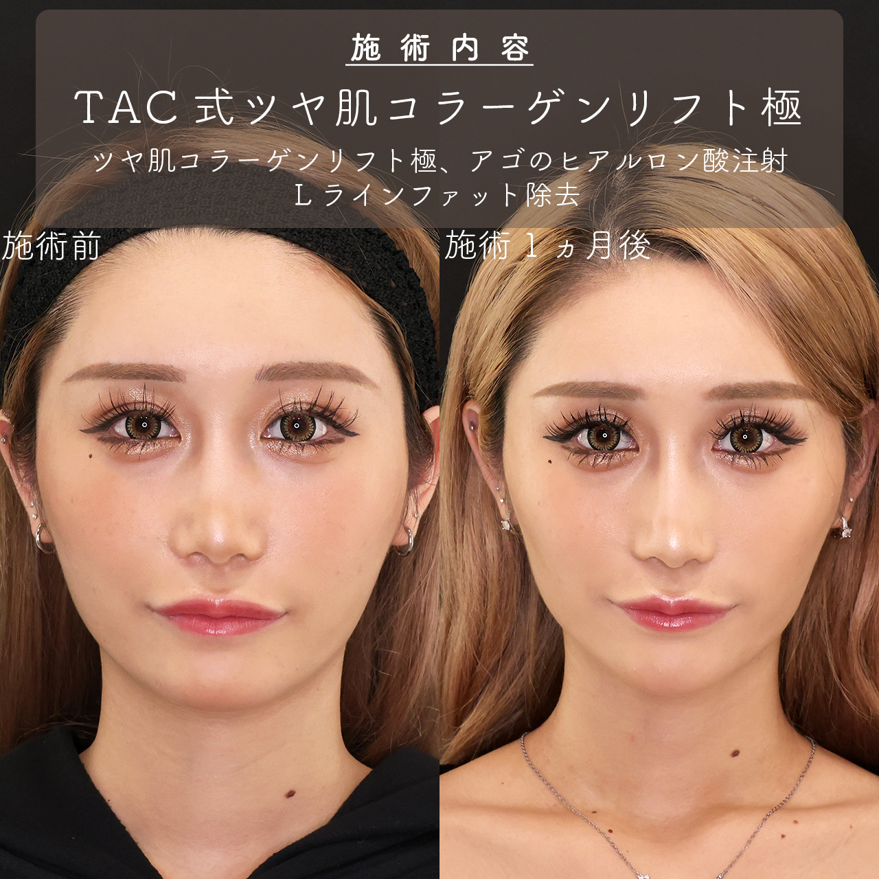 TAC式 ツヤ肌コラーゲンリフト®/Lラインファット除去（エラ下脂肪除去）/顎のヒアルロン酸注射の症例写真 施術前後 