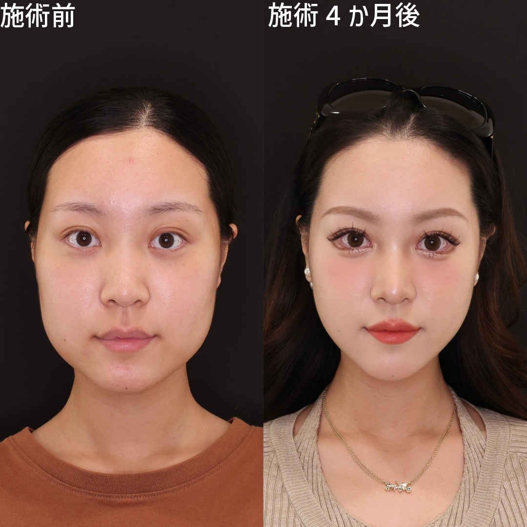 韓国アイドルのような卵型フェイスラインに《韓国流小顔脂肪吸引》
