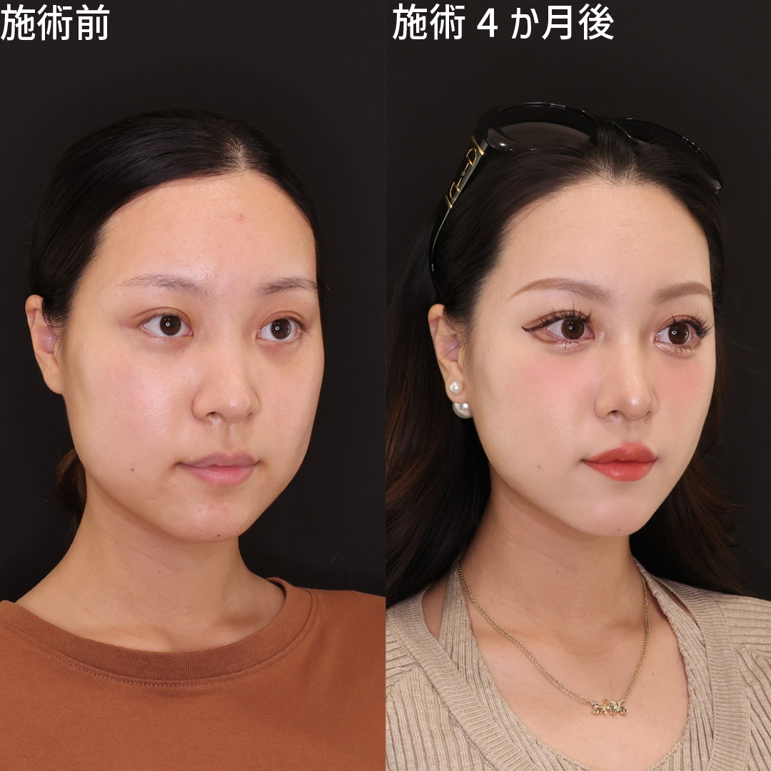 TAC式 ツヤ肌コラーゲンリフト®/ジョールファット除去/顔の脂肪吸引の症例写真 施術前後 