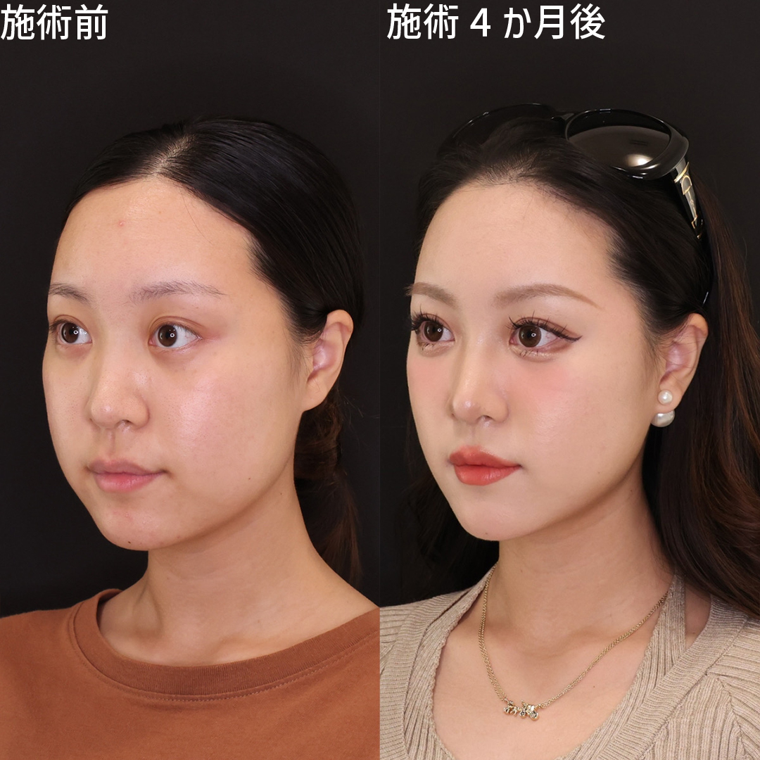 TAC式 ツヤ肌コラーゲンリフト®/ジョールファット除去/顔の脂肪吸引の症例写真 施術前後 