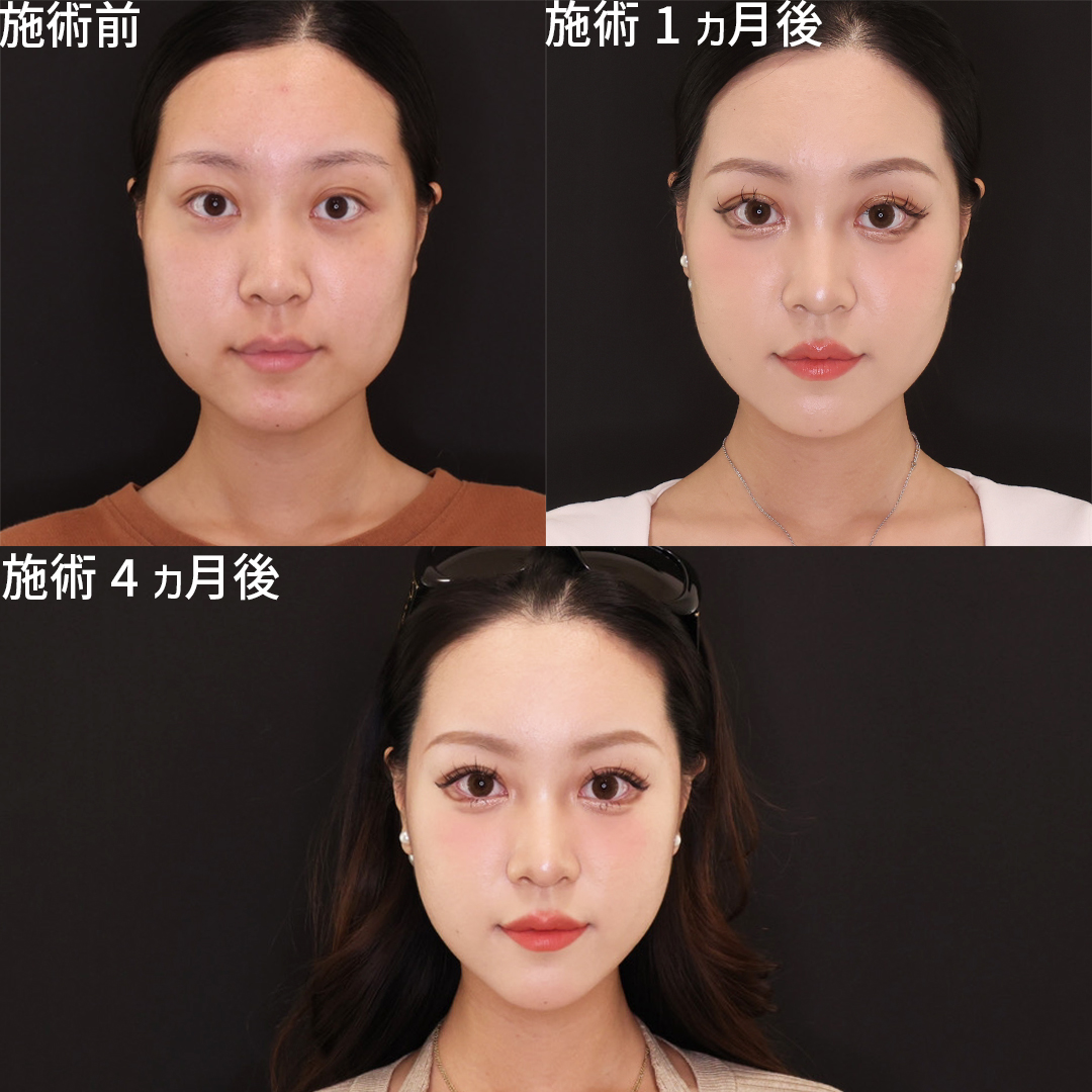 TAC式 ツヤ肌コラーゲンリフト®/ジョールファット除去/顔の脂肪吸引の症例写真 施術前後 