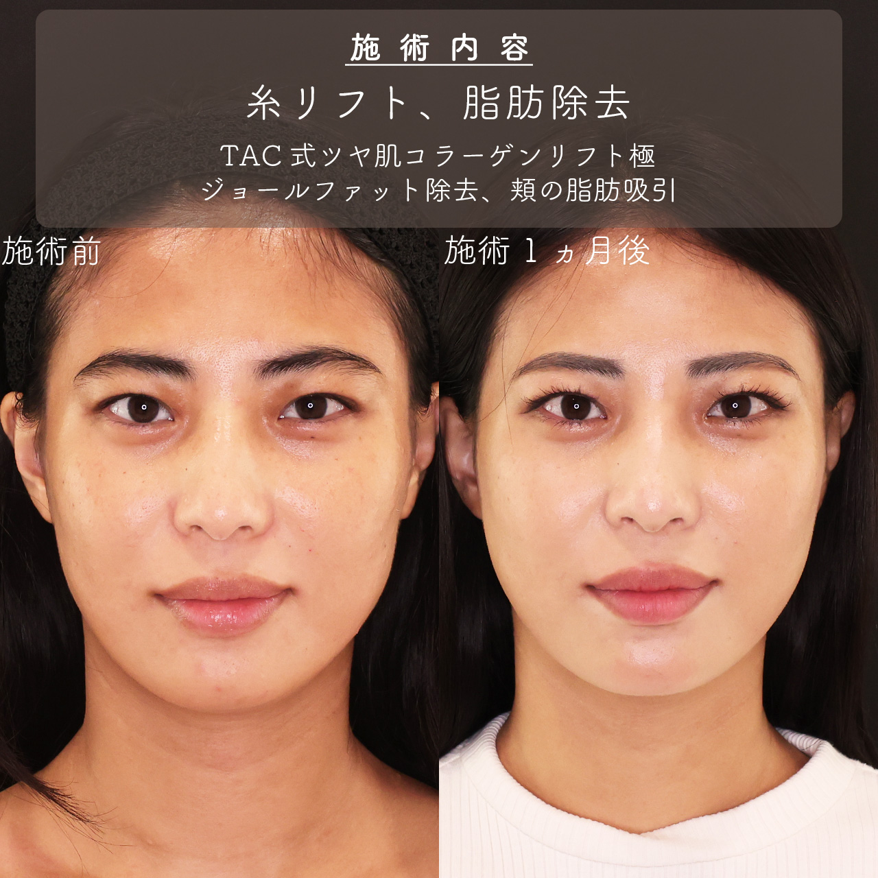 TAC式 ツヤ肌コラーゲンリフト®/ジョールファット除去/顔の脂肪吸引の症例写真 施術前後