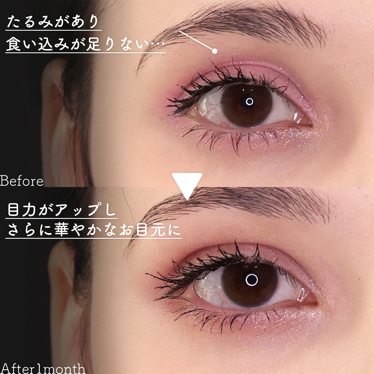 二重埋没法/TAC式 ツヤ肌コラーゲンリフト®/ジョールファット除去の症例写真 施術前後 